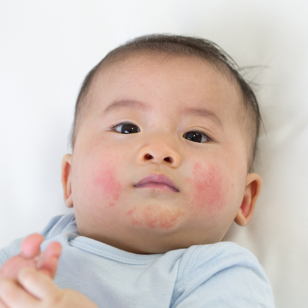 Eczema Relief in Children with Homeopathy