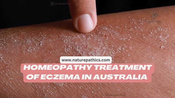Homeopathy treatment for Eczema in Brisbane, Australia